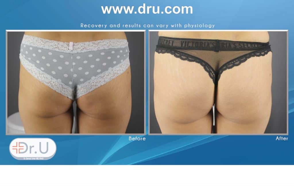 non surgical butt lifting result using HIFEM® (High-Intensity Focused Electromagnetic Energy), Emsculpt non surgical butt lifting result using HIFEM® (High-Intensity Focused Electromagnetic Energy), Emsculpt