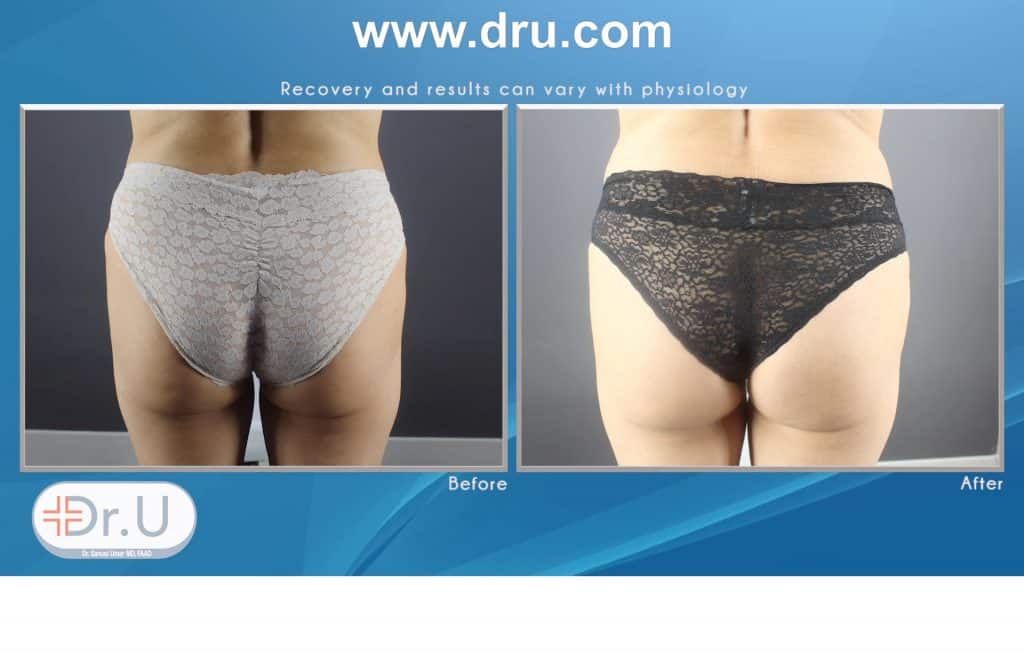 How Does Emsculpt Sculpt Abdomens and Buttocks Without Exercise ? How Does Emsculpt Sculpt Abdomens and Buttocks Without Exercise ?