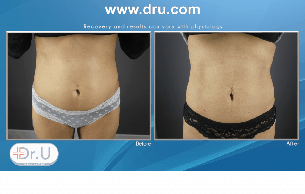 Emsculpt used on the abdomen Emsculpt used on the abdomen