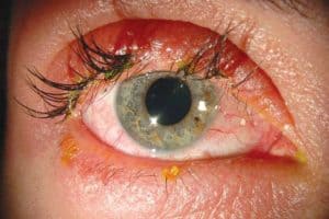 fake eyelashes infection