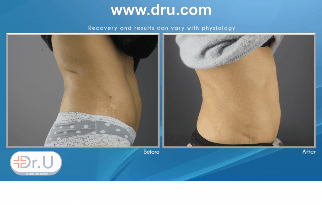 How Does Emsculpt Sculpt Abdomen Without Exercise ? How Does Emsculpt Sculpt Abdomen Without Exercise ?