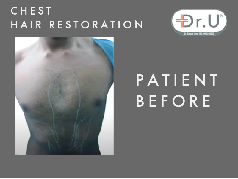 Dr.U's Los Angeles Head to Chest Hair Transplant Patient Before Procedure Dr.U's Los Angeles Head to Chest Hair Transplant Patient Before Procedure