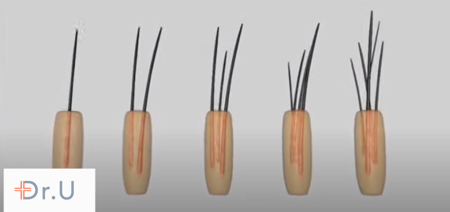 Follicular unit grafts consist of multiple hair follicles wrapped in a bundle. In partial FUE, they are dissected to create two separate hair transplant graft components Follicular unit grafts consist of multiple hair follicles wrapped in a bundle. In partial FUE, they are dissected to create two separate hair transplant graft components