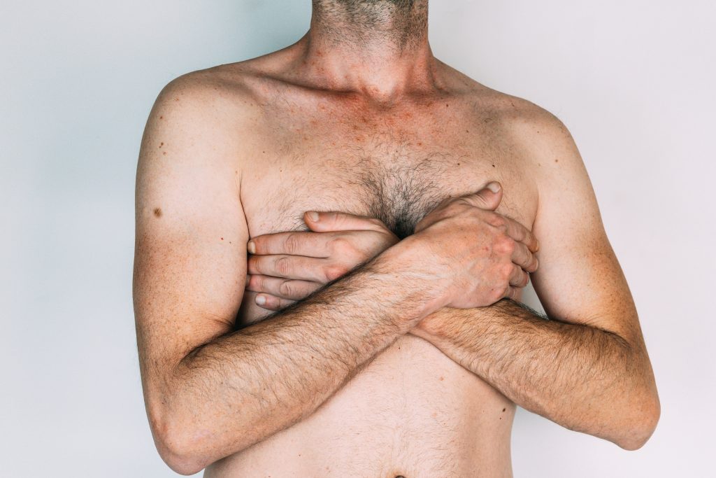 Gynecomastia is quite common and leaves men are embarrassed by their enlarged breast Gynecomastia is quite common and leaves men are embarrassed by their enlarged breast