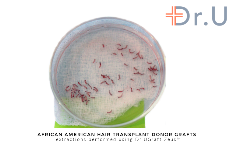 Hair transplant donor grafts harvested using the Intelligent Punch unit of the Dr.UGraft Zeus hair restoration system, invented by Dr.U Hair transplant donor grafts harvested using the Intelligent Punch unit of the Dr.UGraft Zeus hair restoration system, invented by Dr.U
