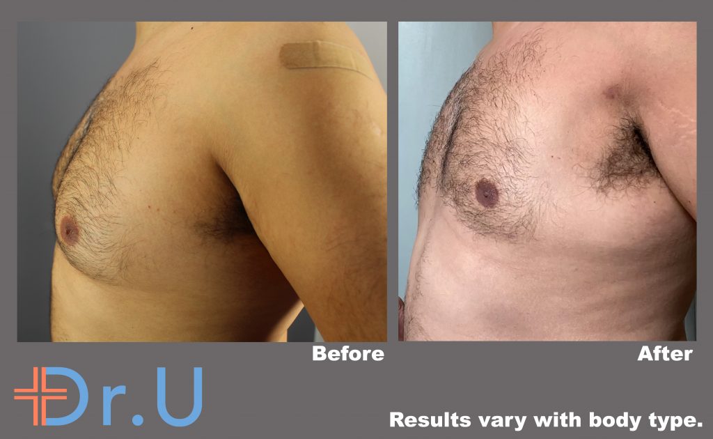 Three quarter's view from the patient's left side showing greatly reduced male breasts following his procedure with BodyTite Three quarter's view from the patient's left side showing greatly reduced male breasts following his procedure with BodyTite