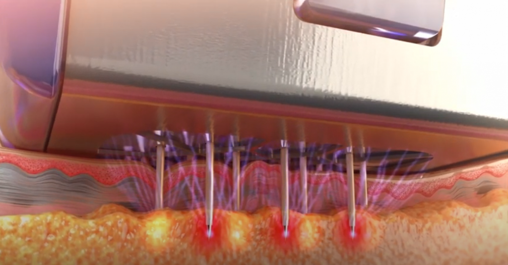 Morpheus8 uses microneedling to apply radiofrequency with pin-point precision to deeper sub-epidermal skin layers Morpheus8- Fat Remodeling With Radiofrequency