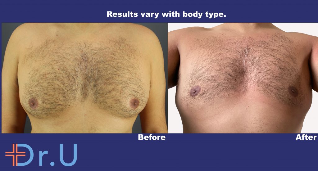 Gynecomastia Removal Results Using Radiofrequency by Dr U With No Linear Scar Gynecomastia Removal Results Using Radiofrequency by Dr U With No Linear Scar