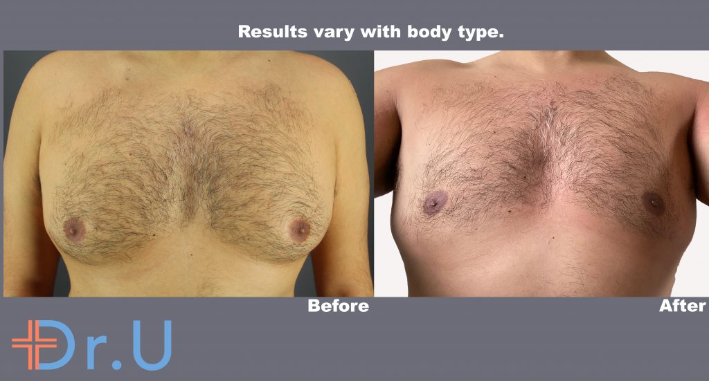 Radiofrequency assisted liposuction (RFAL) for gynecomastia gave this London patient a more masculine-looking chest without linear scarring Radiofrequency assisted liposuction (RFAL) for gynecomastia gave this London patient a more masculine-looking chest without linear scarring