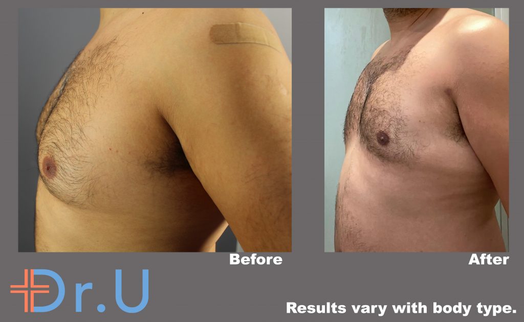Three quarter's view from the patient's left side showing greatly reduced male breasts following his procedure with BodyTite Three quarter's view from the patient's left side showing greatly reduced male breasts following his procedure with BodyTite