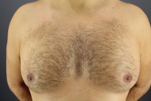 Gynecomastia affects young teens and men of a variety of ages Gynecomastia affects young teens and men of a variety of ages