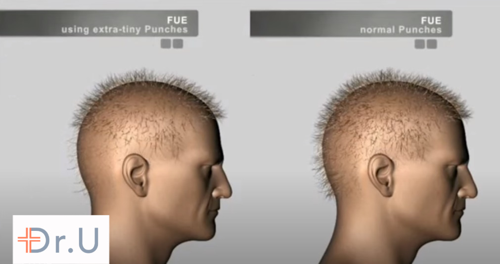 Comparing the results of partial FUE on the left to regular FUE on the right. Partial FUE produces a depleted end appearance. Comparing the results of partial FUE on the left to regular FUE on the right. Partial FUE produces a depleted end appearance.