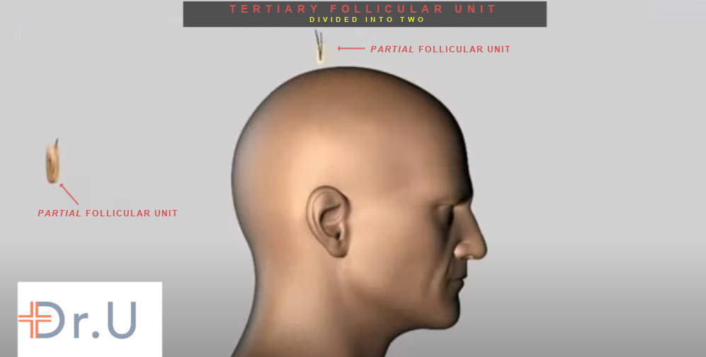 No new hair is created with partial FUE (p-FUE). Dividing a tertiary follicular unit into two components still equates to three hairs. No new hair is created with partial FUE (p-FUE). Dividing a tertiary follicular unit into two components still equates to three hairs.