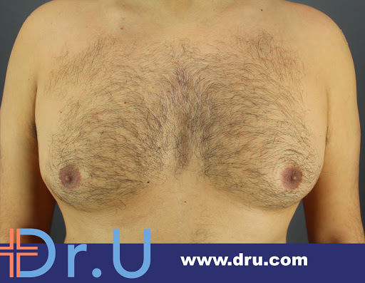 London man struggles with man boobs and requires a gynecomastia surgery by Dr.U London man struggles with Man Boobs