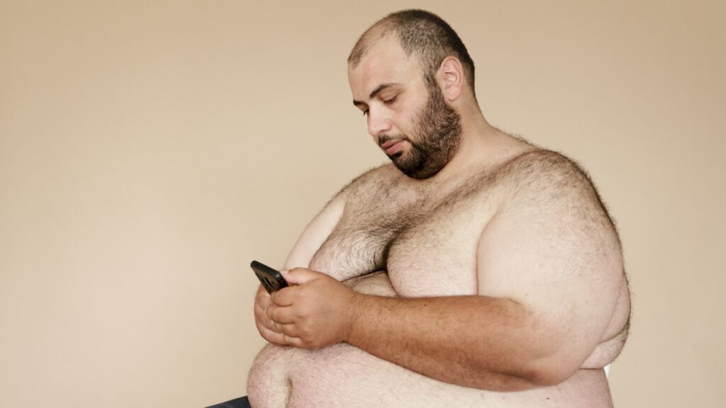 Obesity in males is the most common contributing factor to gynecomastia Obesity in males is the most common contributing factor to gynecomastia