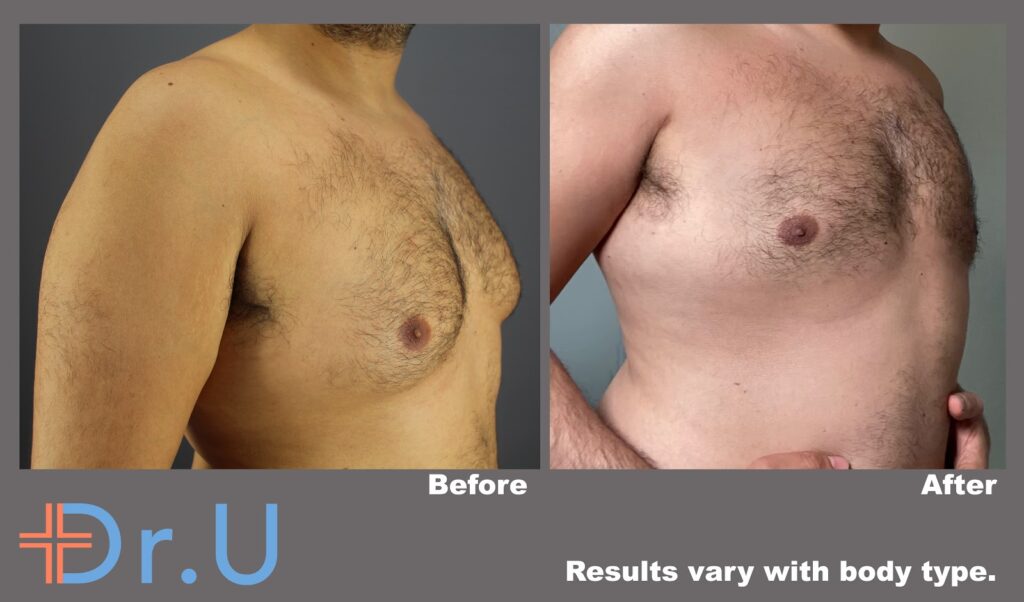 Three quarter's view from the right side showing a significant reduction of this patient's male breasts following his procedure * Three quarter's view from the right side showing a significant reduction of this patient's male breasts following his procedure *