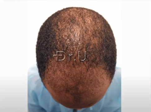 Top view of patient's head at the Norwood 5 hair loss level Top view of patient's head at the Norwood 5 hair loss level