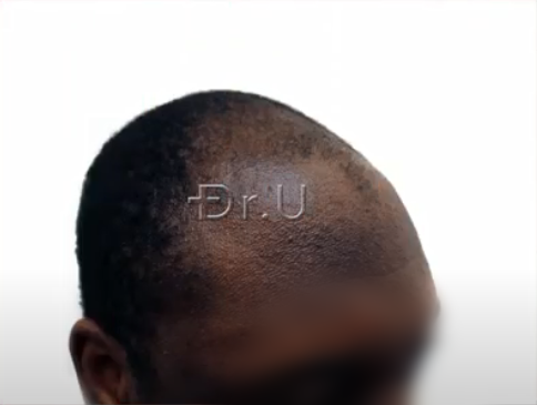 Right view of black male patient's receded temples Right view of black male patient's receded temples