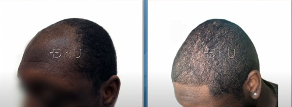 Left side view of black male patient's new hairline and temples. He now sports an age-appropriate appearance thanks to his hair transplant procedure performed by Dr. U Left side view of black male patient's new hairline and temples. He now sports an age-appropriate appearance thanks to his hair transplant procedure performed by Dr. U