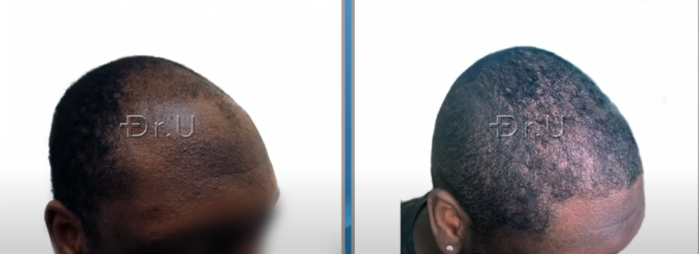 Before and after photos depict fuller coverage and well-designed temples, shown on the right side of this patient's face Before and after photos depict fuller coverage and well-designed temples, shown on the right side of this patient's face