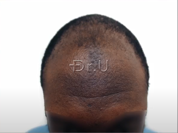 Patient's hairline had receded considerably causing him to appear much older than his actual age. Patient's hairline had receded considerably causing him to appear much older than his actual age.