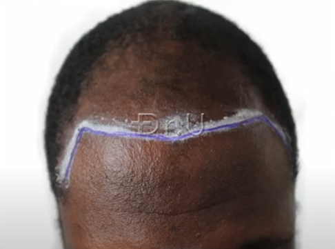 Dr.U planned a new hairline and temples to frame the patient's face and help him achieve a much younger looking appearance. Dr.U planned a new hairline and temples to frame the patient's face and help him achieve a much younger looking appearance.
