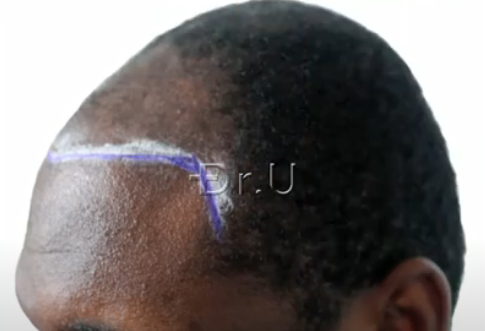 Left side view of Dr. Umar's planning for patient's hairline and temples Left side view of Dr. Umar's planning for patient's hairline and temples