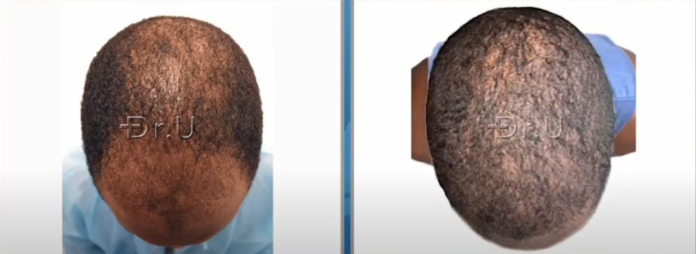 Top of black male patient's head now has more coverage through the use of just 3000 grafts Top of black male patient's head now has more coverage through the use of just 3000 grafts