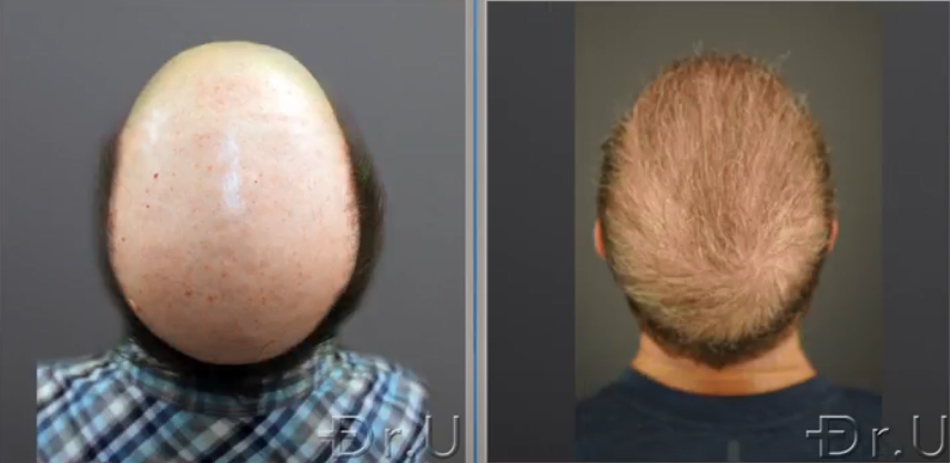 Patient's crown now has a natural-looking whorl Patient's crown now has a natural-looking whorl