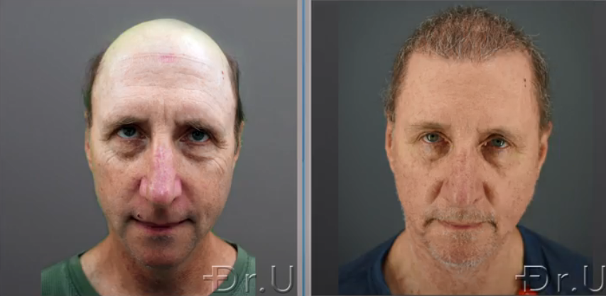 Before and after photos show the front view of Dr.U's patient at 8 months following his Dr.UGraft Zeus procedure Before and after photos show the front view of Dr.U's patient at 8 months following his Dr.UGraft Zeus procedure