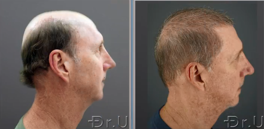 A side view of the patient's outcome shows an incredible improvement in his coverage after Dr UGraft Zeus severe baldness hair transplant A side view of the patient's outcome shows an incredible improvement in his coverage after Dr UGraft Zeus severe baldness hair transplant