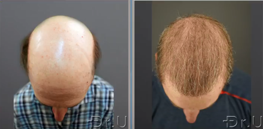 The top of this patient's head is no longer bald thanks to the prolific growth of his donor grafts The top of this patient's head is no longer bald thanks to the prolific growth of his donor grafts