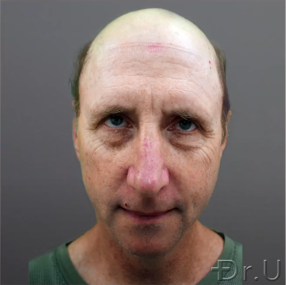 Front view of a severely bald patient who wishes to change his appearance through hair transplant surgery. Front view of a severely bald patient who wishes to change his appearance through hair transplant surgery.