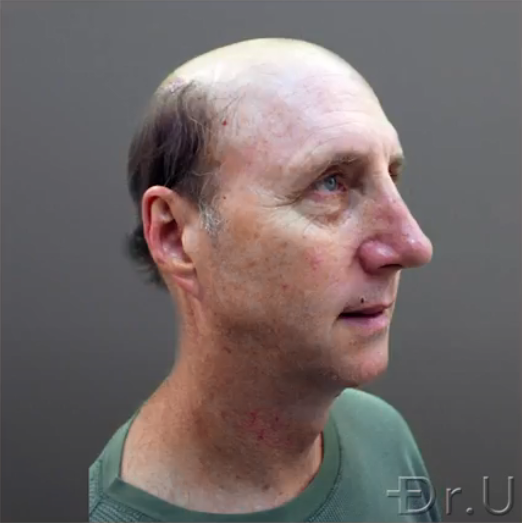 Side view of Dr.U's patient whose hair loss stage is worse than Norwood 7 Side view of Dr.U's patient whose hair loss stage is worse than Norwood 7