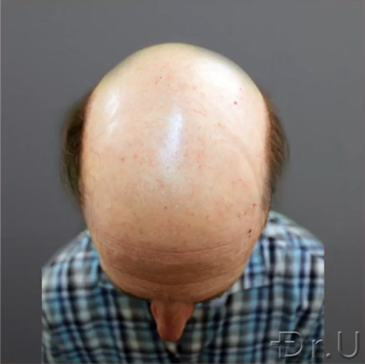 The top of the patient's head shows absolutely no hair growth The top of the patient's head shows absolutely no hair growth