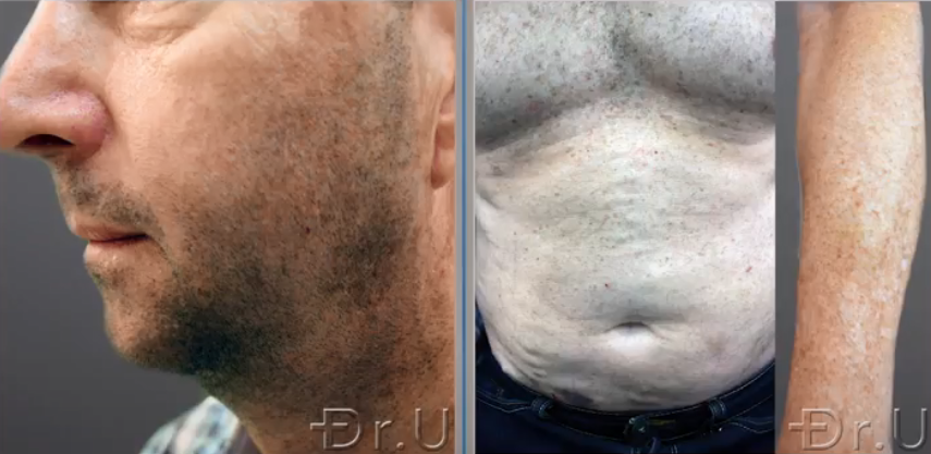 Donor hair was harvested from the hair transplant patient's face, torso, and arm Donor hair was harvested from the hair transplant patient's face, torso, and arm