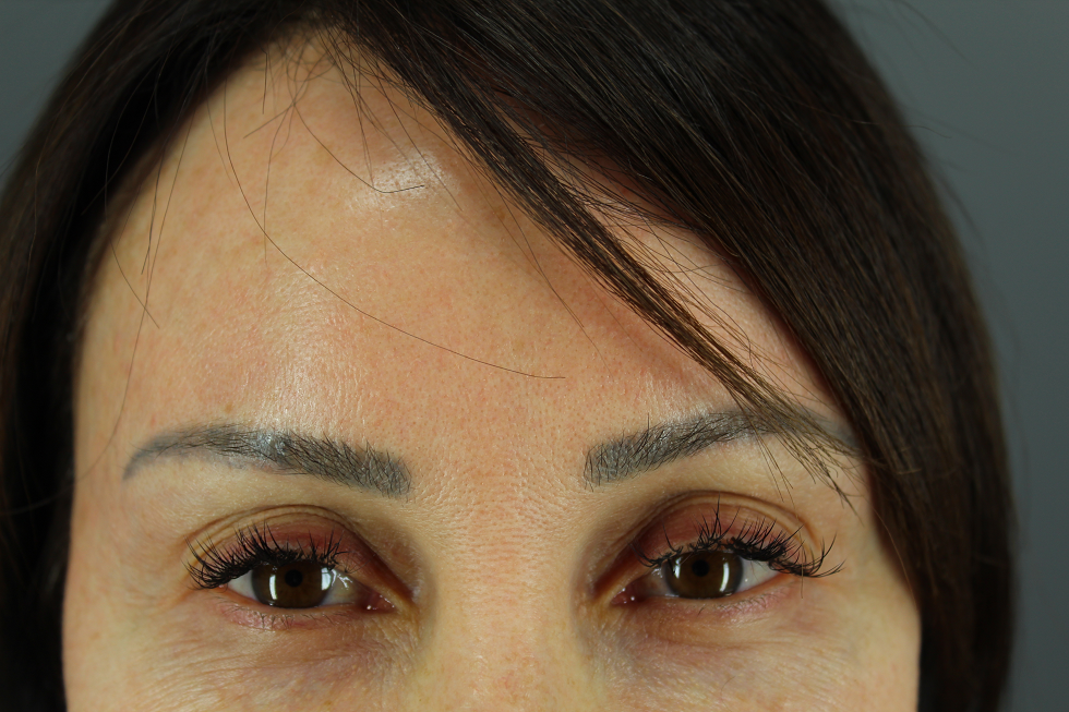Patient hopes to get rid of unwanted discoloration on her forehead Patient hopes to get rid of unwanted discoloration on her forehead
