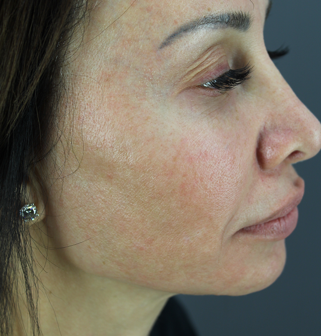 Profile view shows pronounced pigmentation and facial redness caused by sun exposure Profile view shows pronounced pigmentation and facial redness caused by sun exposure