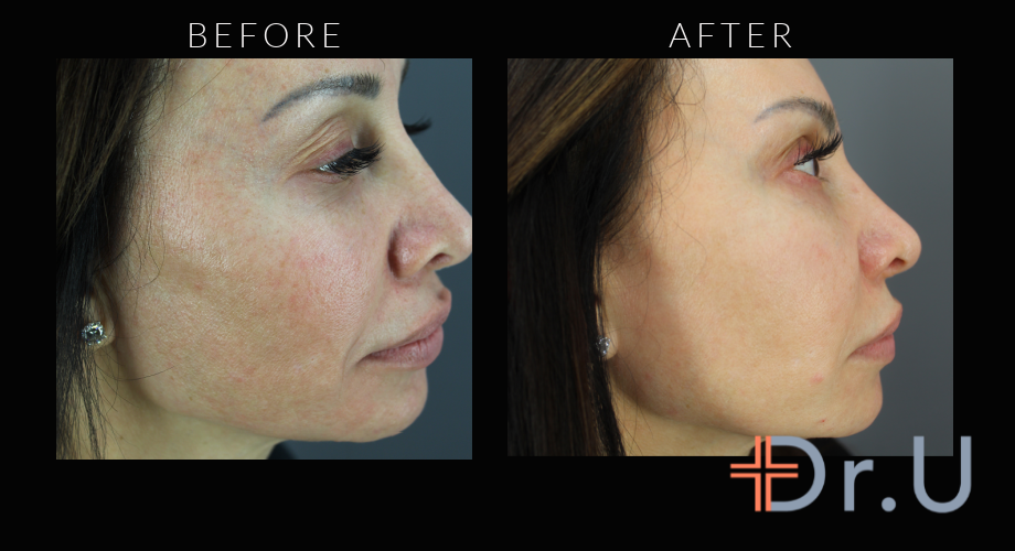 Profile View - Morpheus For Face Treatment
