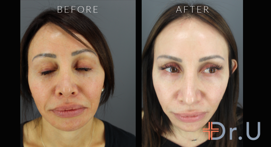 Morpheus for Face - Age Spots and Hyperpigmentation